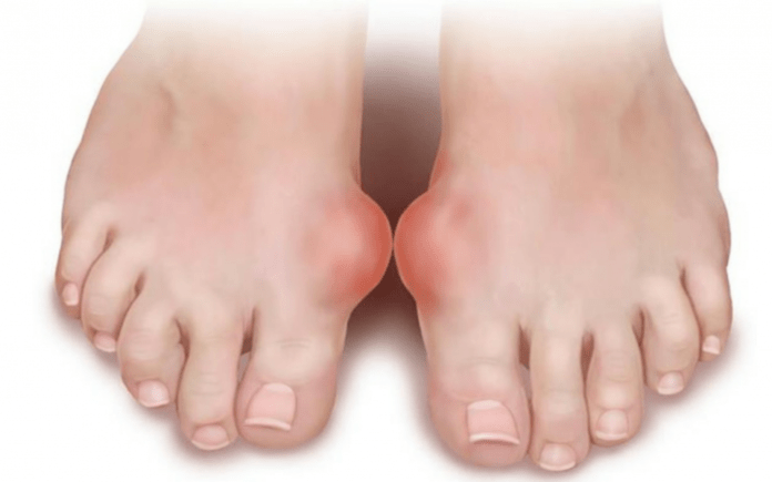 deformácia chodidla ako príčina vzhľadu huby na nohách
