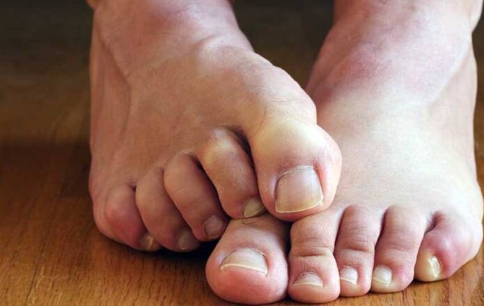 príznaky dlaždicových húb na nohách