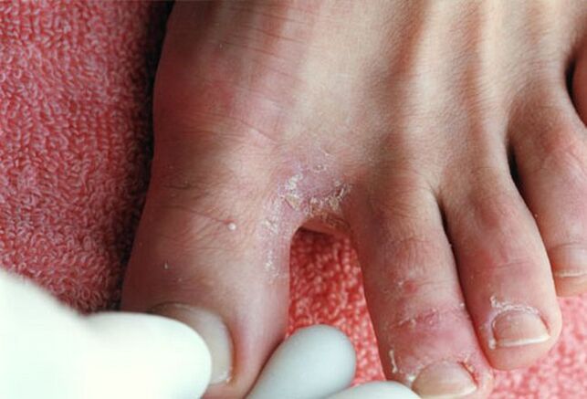 príznaky huby medzi prstami na nohách