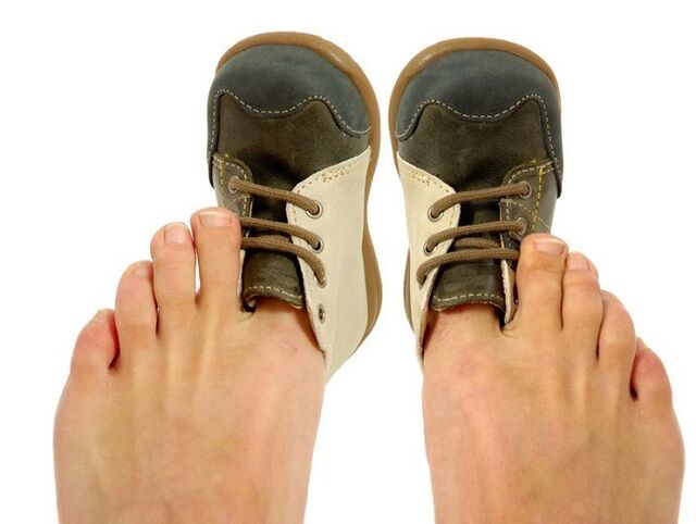 tesné topánky ako príčina plesne medzi prstami na nohách