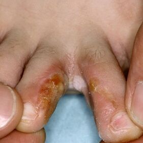 Príznaky huby medzi prstami na nohách